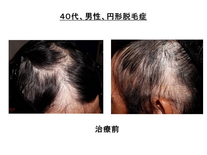 円形脱毛症　病院